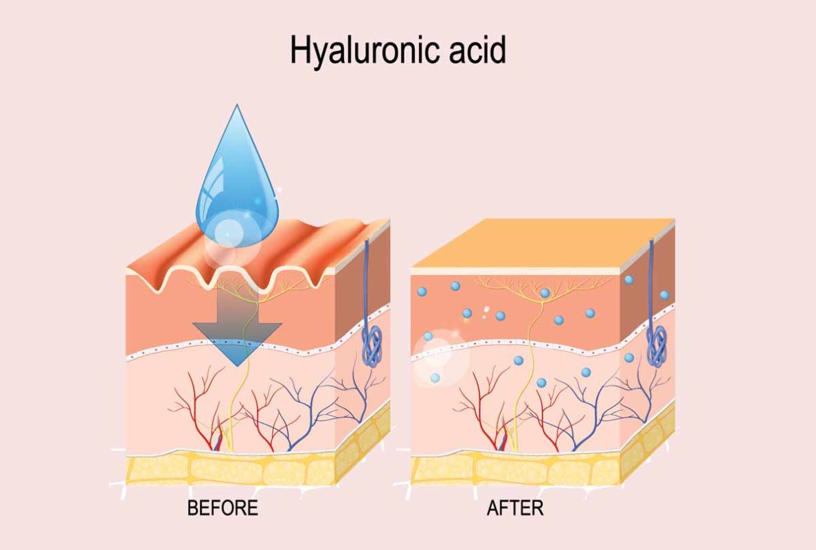 Eine Grafik der verschiedenen Hautschichten vor und nach einer Behandlung mit Hyaluronsäure.