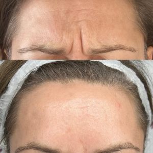 Botox Price-Botox in Wien