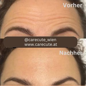 Botox in Wien-Botox Price